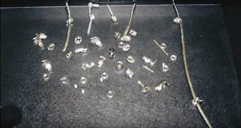 Фото титановых имплантатов, выпавших из тел людей после молитвы