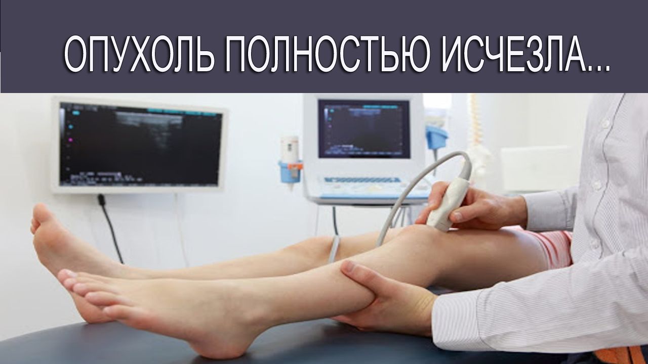 Одна опухоль полностью исчезла…