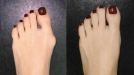 Growing “Bunions” on My Feet: Healing After Using Anointed Pieces of Paper