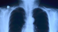 Left-sided pneumonia healed in one day