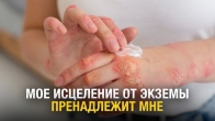 My Healing from Eczema Belongs to Me