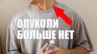 Величезна пухлина на шиї зникла вночі