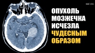 Cerebellar tumor disappeared miraculously